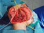 Intraoperative: lymphatic malformation of the parotid gland