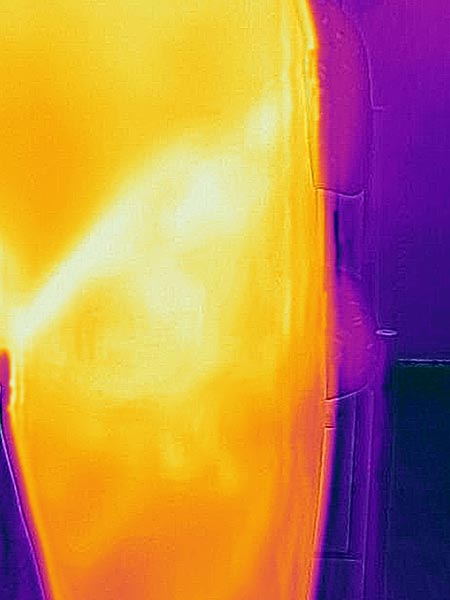 Infrared thermography: area of the residuum of the NICH is still slightly warmer