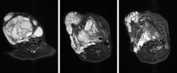 MRI: lymphatic malformation