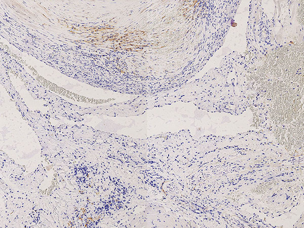 Histopathology D2-40 staining – Upper airway obstruction