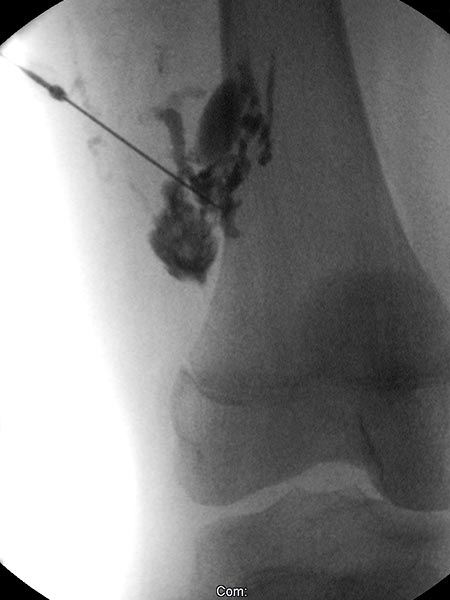 X-ray: after direct puncture of the venous malformation