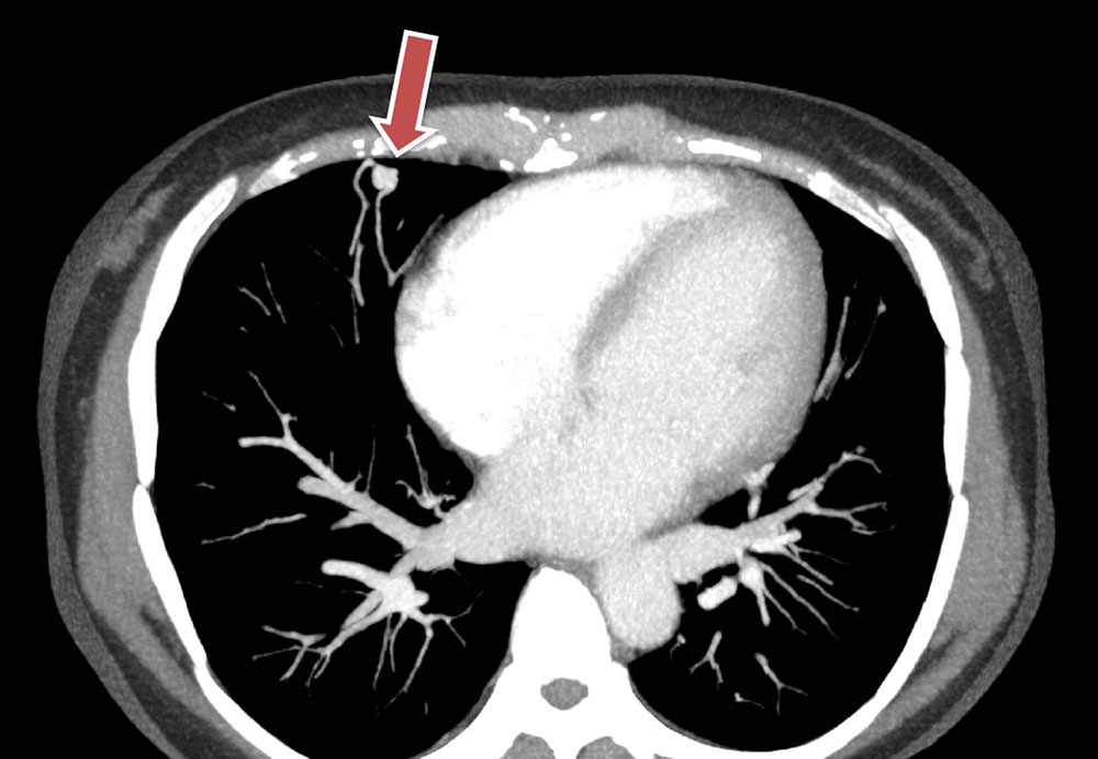 CT – Arteriovenous fistula