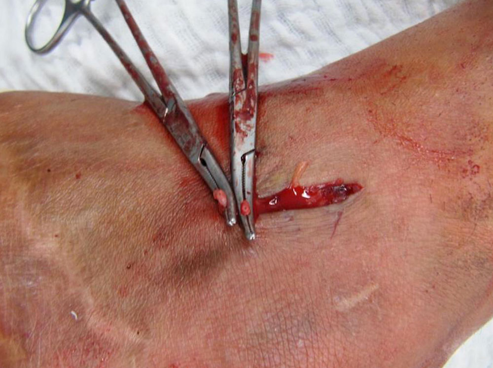 Surgical site on the left lateral malleolus