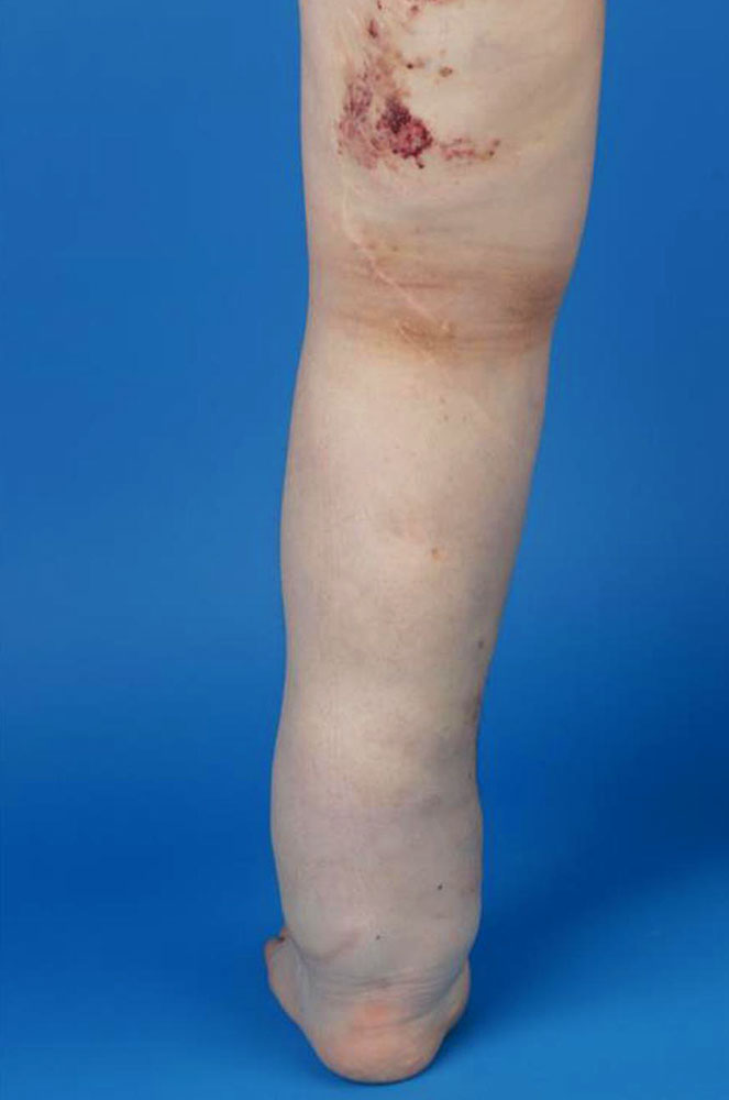 Combination of lymphatic malformation and primary lymphedema