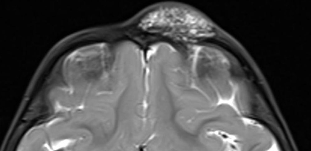 Lymphatic malformation on MRI