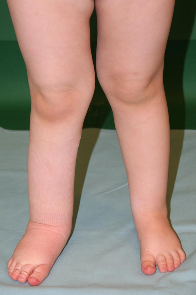 Primary ymphedema of the right leg