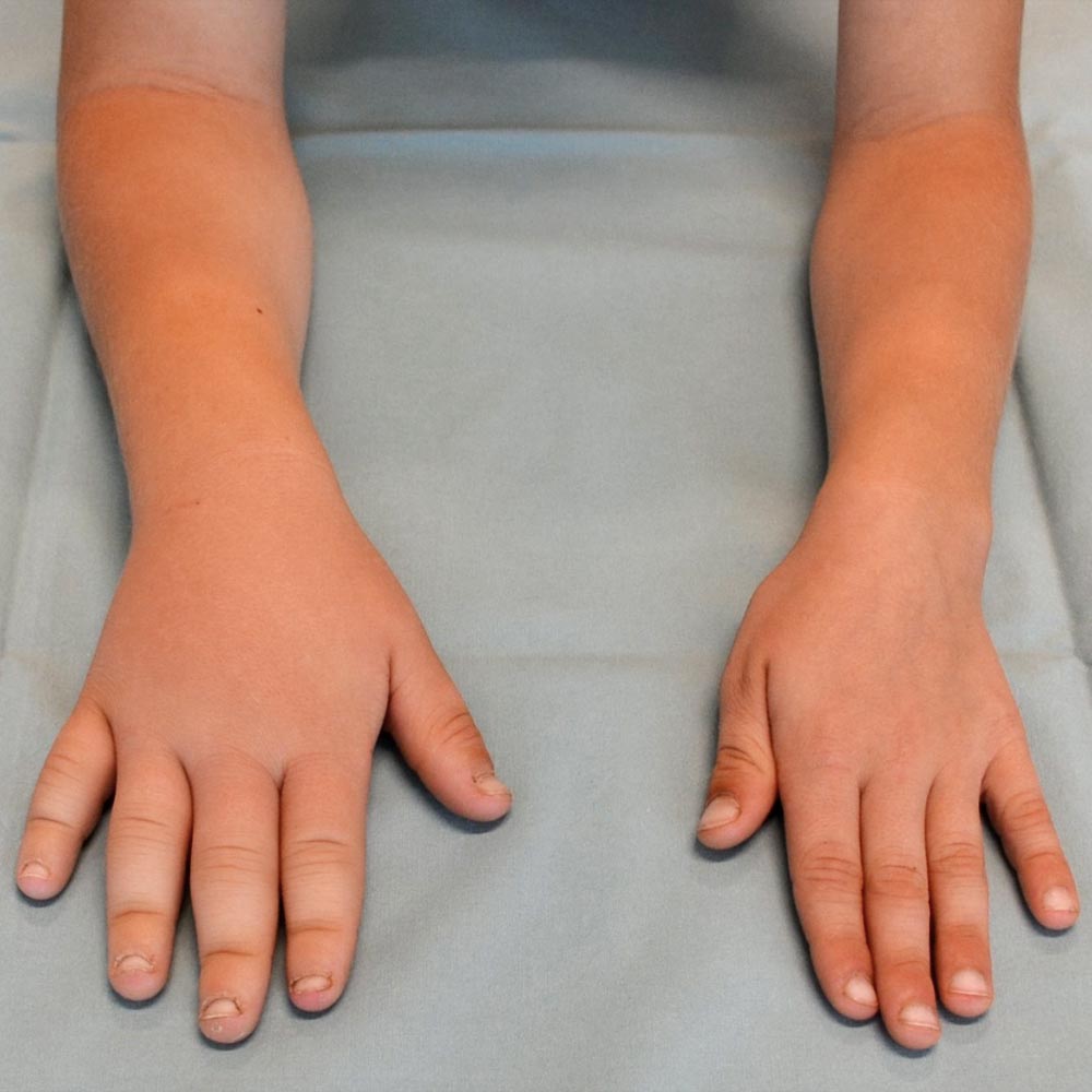 Asymmetric swelling of the fingers