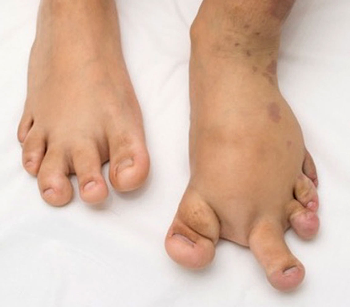 Hyperplasia of the feet in CLOVES syndrome