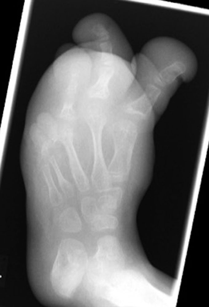 X-ray of a foot in CLOVES syndrome