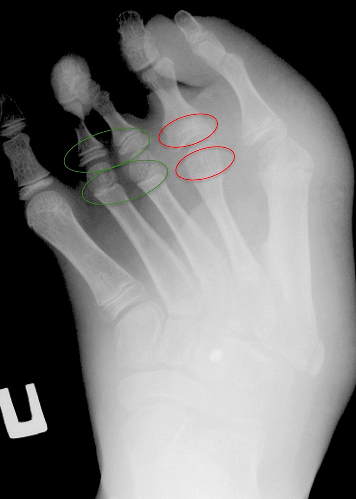 X-ray: Overgrowth of the foot