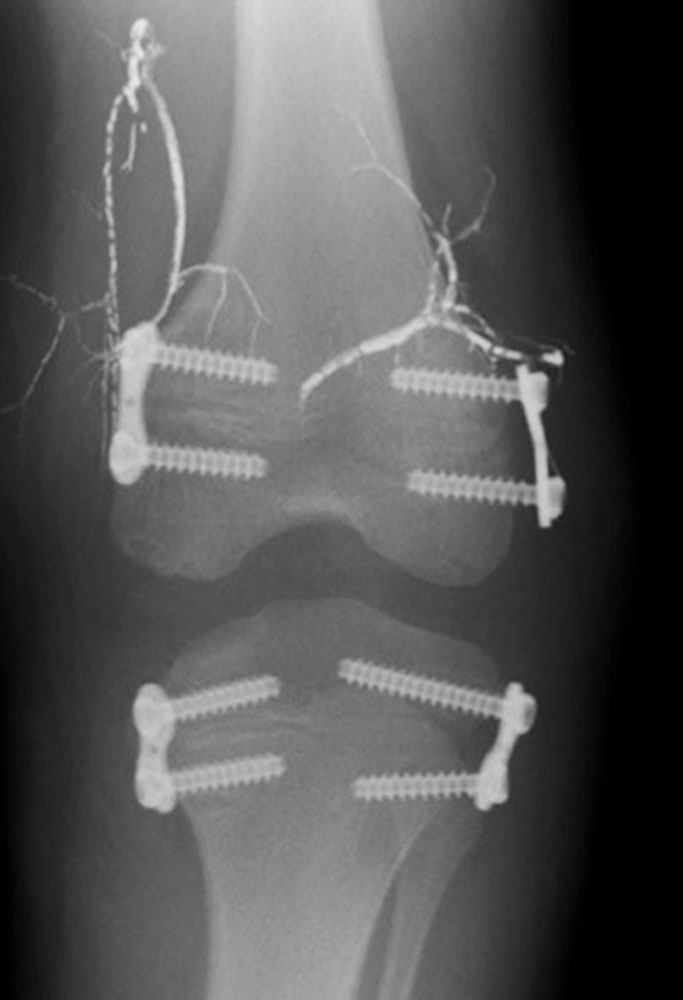 X-ray: Epiphysiodesis