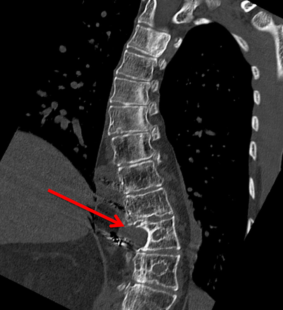 CT: rotational scoliosis