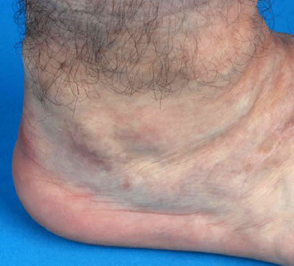 Patient with venous malformation