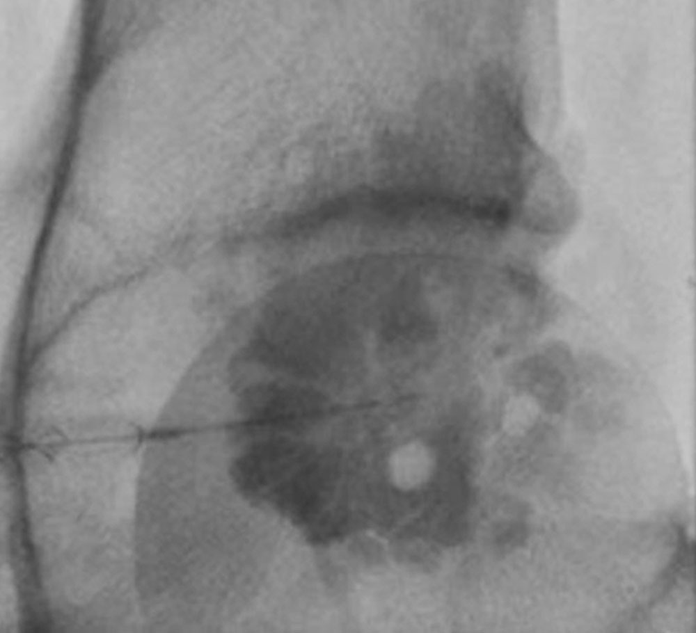 X-ray: thrombi within a venous malformation