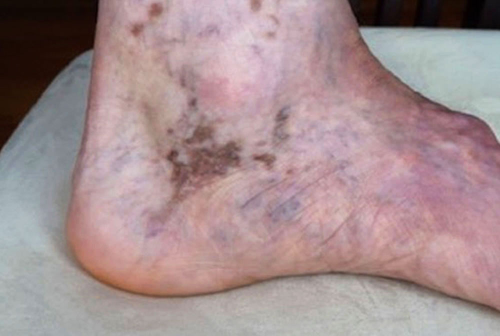 Purpura jaune d'ocre in a patient with combined capillary-venous malformation