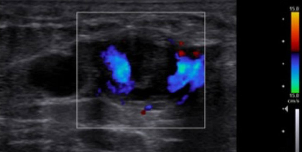 Color-coded duplex sonography: thrombus