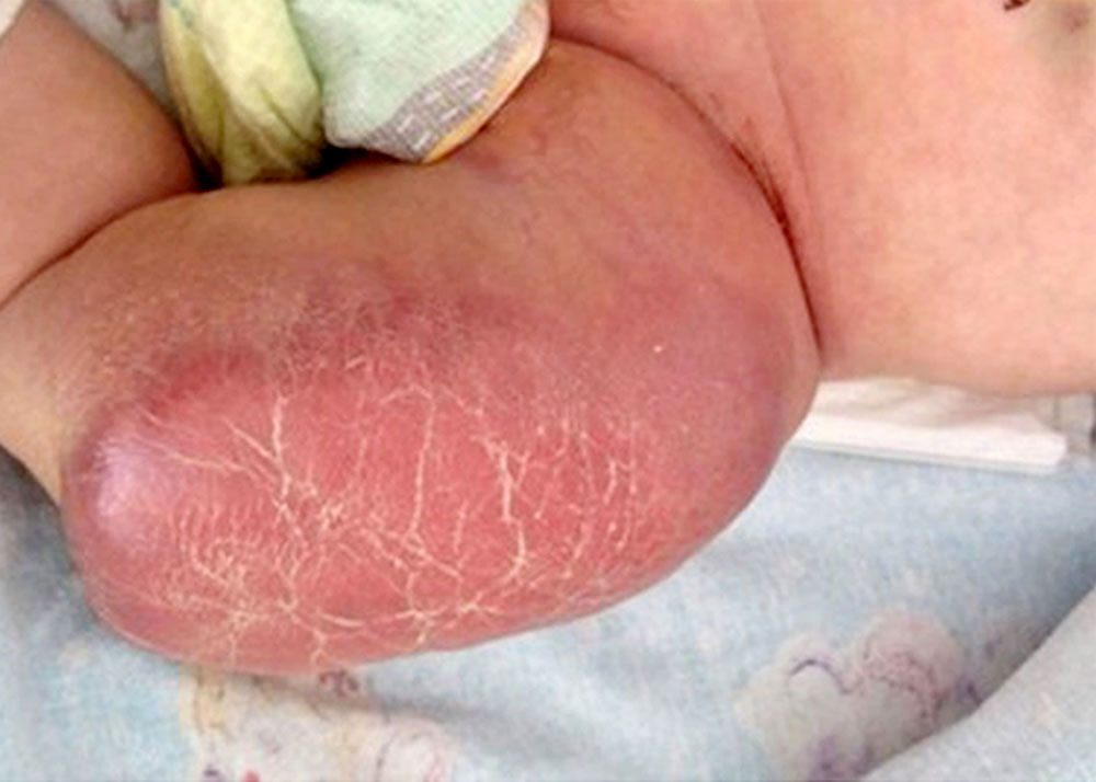 Photograph of a kaposiform hemangioendothelioma in an infant