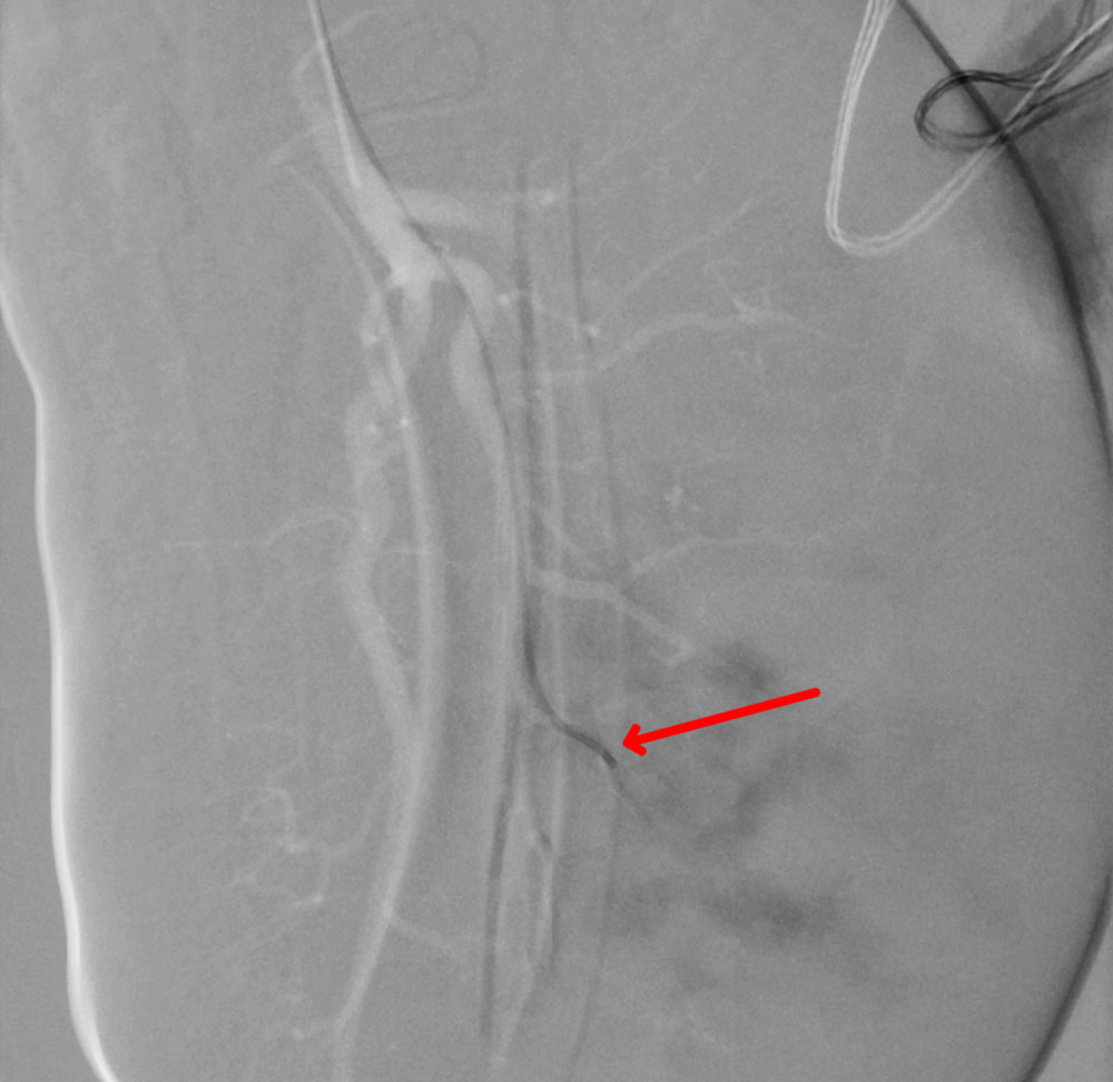 DSA: radiological interventional embolization in an infant with KHE