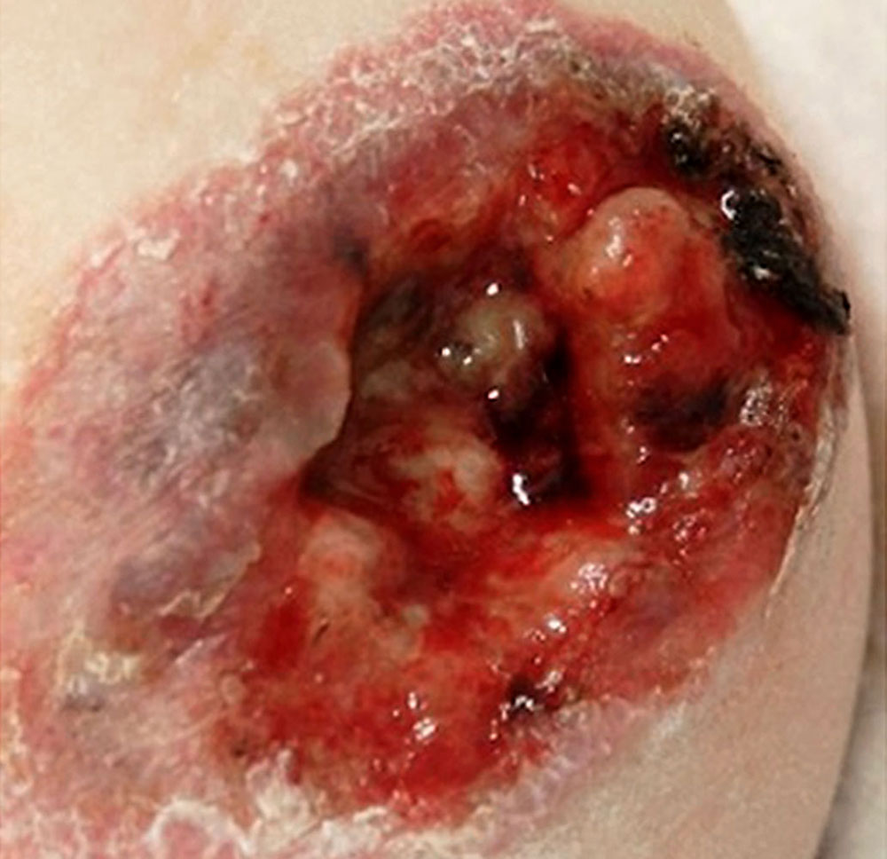 Infantile hemangioma with ulceration and exudation