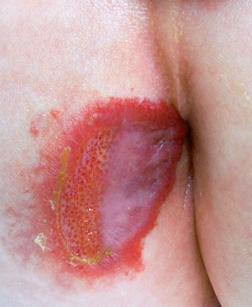 Ulceration of an infantile hemangioma in different stages of wound healing