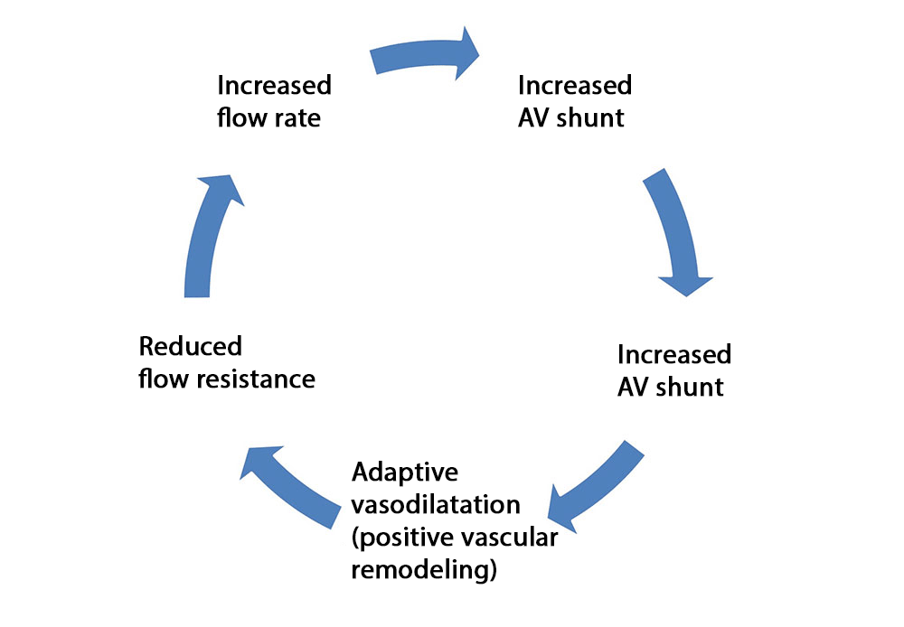 Vicious circle in arteriovenous malformation