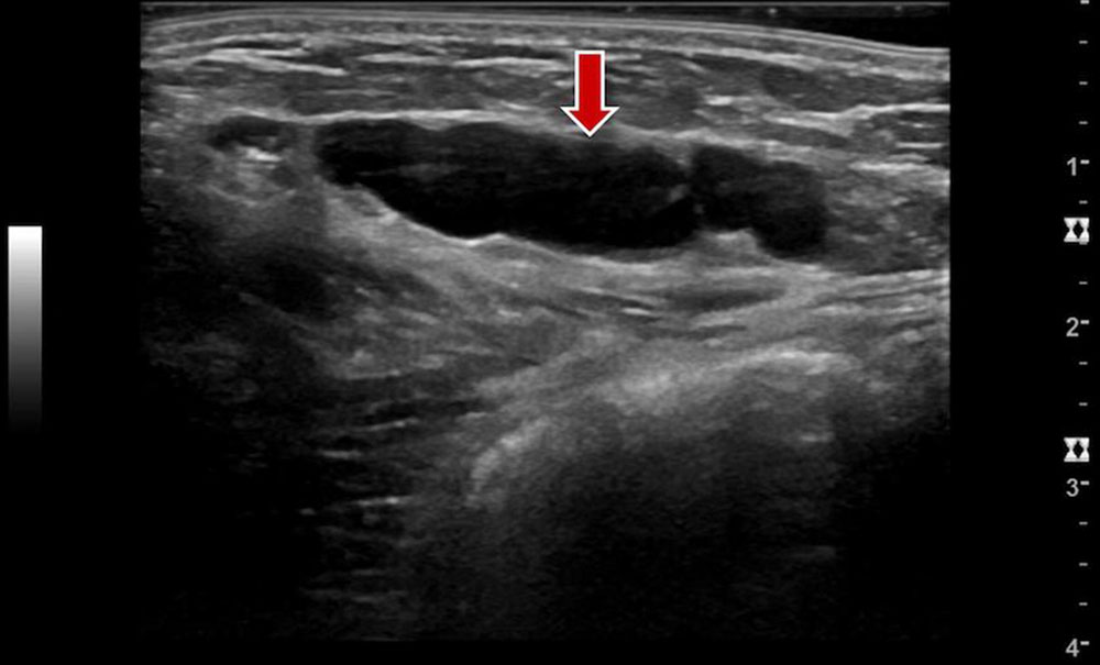 Ultrasound findings of a macrocystic lymphatic malformation