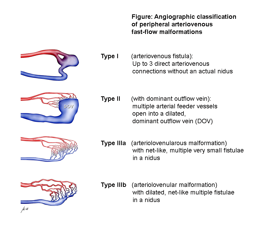 Angiographic classification