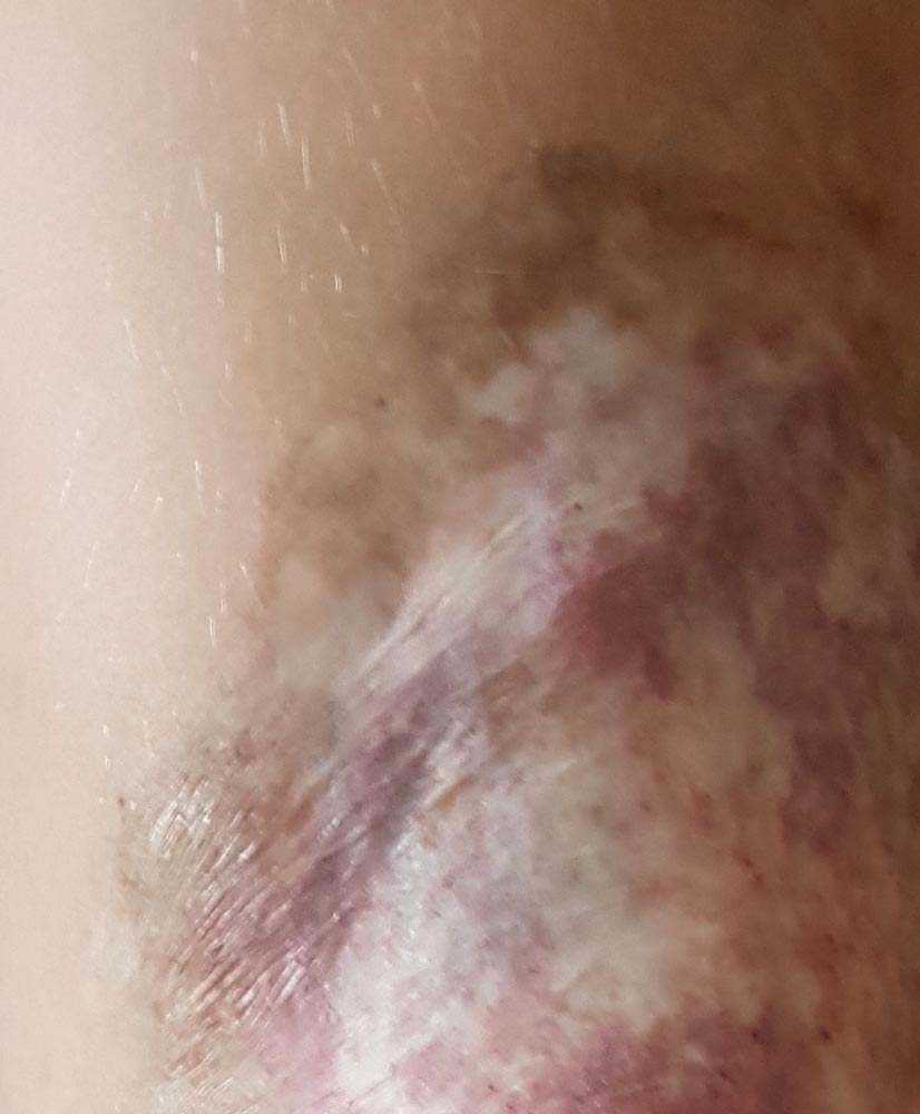 Skin atrophy after multiple laser therapies of a capillary malformation