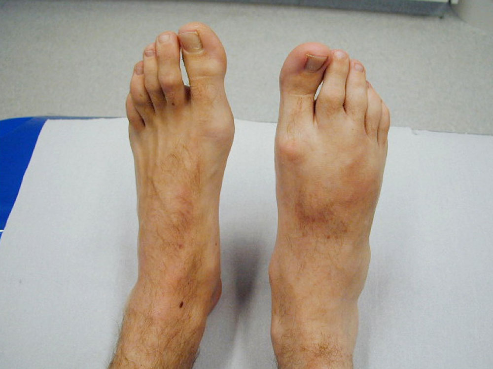 Venous malformation on the right foot