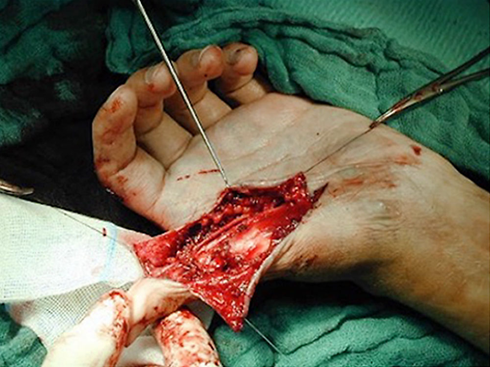 Surgical site after resection of the arteriovenous malformation