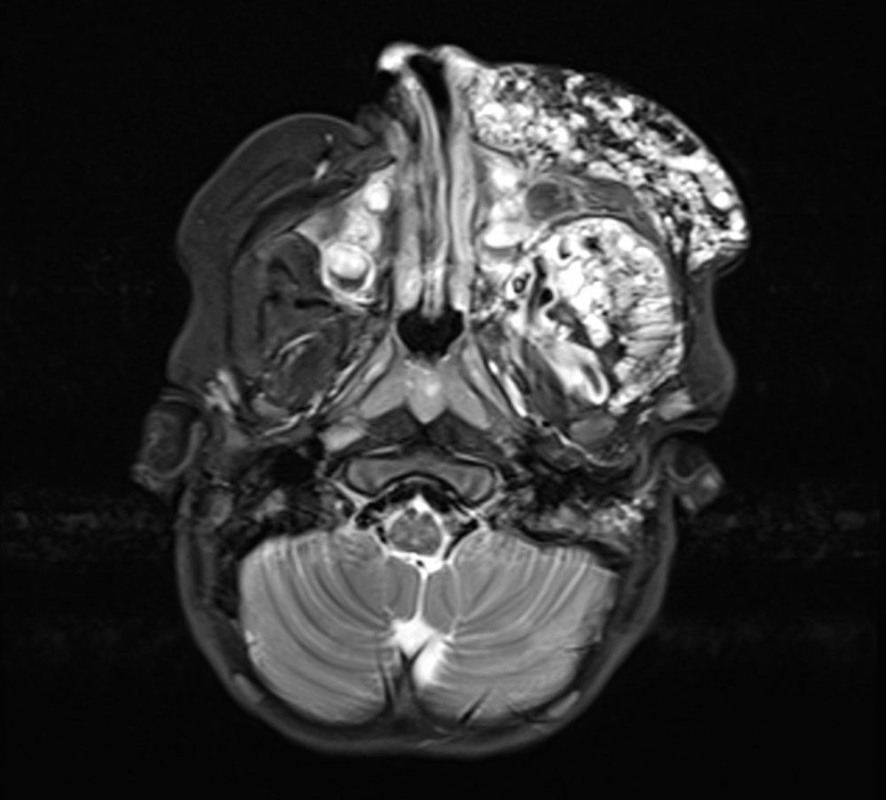 MRI of the venous malformation
