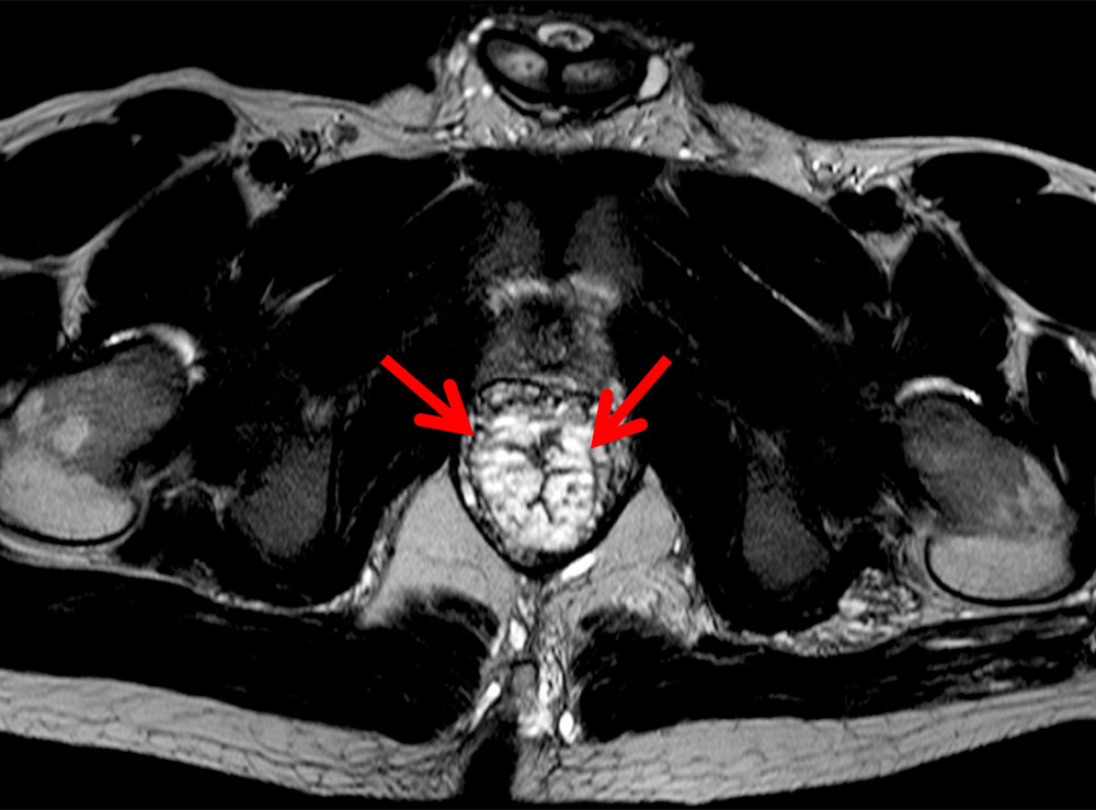 MRI: submucosal venous malformation in the rectum