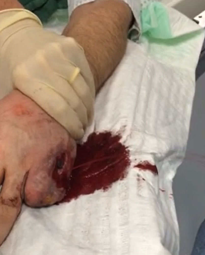 Massive arterial bleeding from an ulceration on the lateral hand