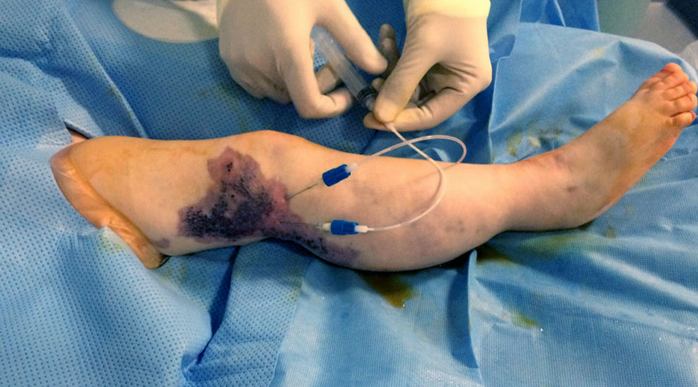 Sclerotherapy in a patient with Klippel-Trénaunay syndrome