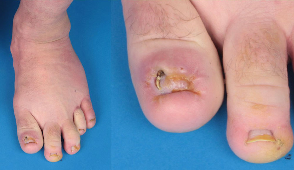 Ballooned hyperplasia of the foot 
