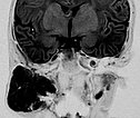 MRI: extent of the hemangioma