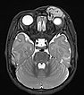 MRI: infantile hemangioma on the eyelid