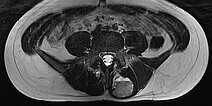 MRI  – Intramuscular venous malformation