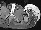 MRI: tumor in the left groin