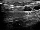 Ultrasound-guided puncture: lymphatic malformation