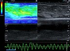 Ultrasound elastography – Subcutaneous infantile hemangioma