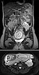 MRI: venous malformation