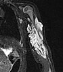 MRI – Subcutaneous infantile hemangioma