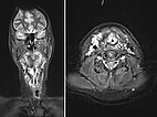 MRI – Upper airway obstruction