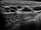 Sonography: macrocystic malformation on the abdominal wall