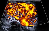 Power Doppler imaging – Subcutaneous infantile hemangioma
