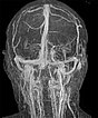 MR angiography: venous malformation