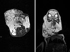 MRI: lymphatic malformation of the face