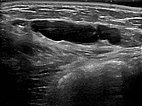 Sonography: macrocystic malformation on the abdominal wall