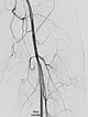 MR angiography: tumor vascularization is successfully